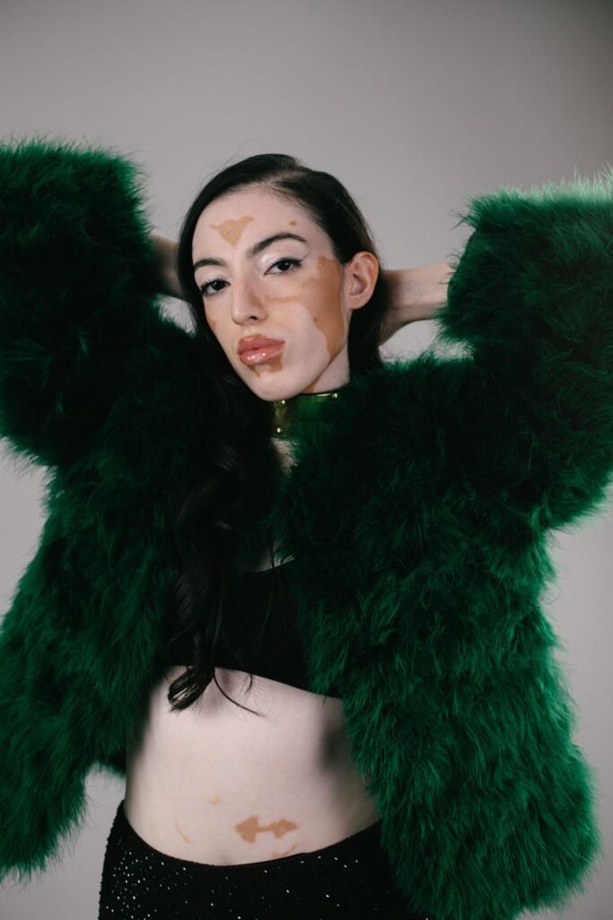 Jasroop a model at Zebedee with vitiligo models in a bra top with see through skirt and green faux fur coat. 